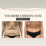 Abdominoplasty