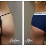 Brazilian Butt lift (BBL)