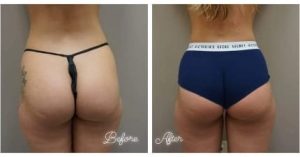 Brazilian Butt lift (BBL)