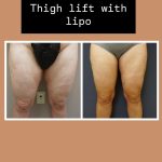 Thigh lift (Thigh Plasty)