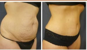 Abdominoplasty