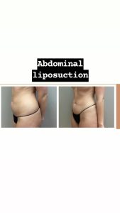 Liposuction of the abdomen and waist