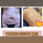 abdominoplasty