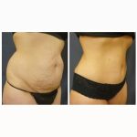 abdominoplasty