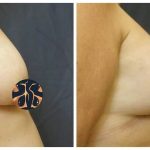 Breast Lift with implants