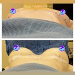 Breast Augmentation