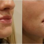 Liquid rhinoplasty