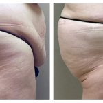 Brazilian Butt lift (BBL)