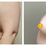 Breast lift with reduction