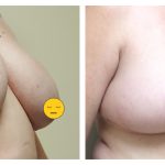 Breast lift with reduction wise anchor