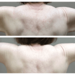 Arm Lift (Brachioplasty)