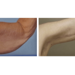Arm Lift (Brachioplasty)