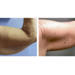 Arm Lift (Brachioplasty)