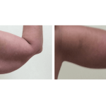Arm Lift (Brachioplasty)