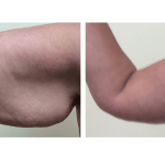 Arm Lift (Brachioplasty)