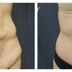 Abdominoplasty
