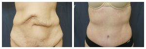 Abdominoplasty