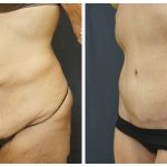 Abdominoplasty