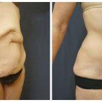 Abdominoplasty