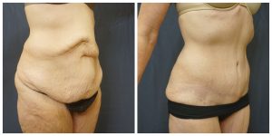 Abdominoplasty