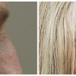 Upper blepharoplasty with brow lift
