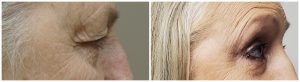 Upper blepharoplasty with brow lift