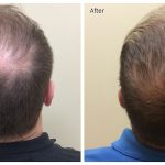 PRP hair restoration
