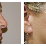 Cheek augmentation (Implants)