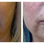 Lip Augmentation with HA filler