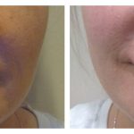 Lip Augmentation with HA filler