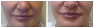 Lip Augmentation with HA filler