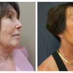 Face and neck lift