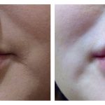Lip Augmentation with HA filler