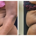 Abdominoplasty with hernia and muscle repair