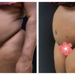 Abdominoplasty with hernia and muscle repair