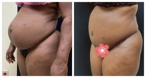 Abdominoplasty with hernia and muscle repair