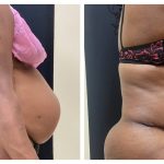 Abdominoplasty with hernia and muscle repair