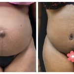 Abdominoplasty with hernia and muscle repair