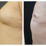 Chest liposuction with excision of gynecomastia