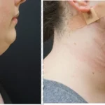 submental liposuction with Vaser and Renuvion