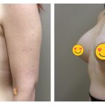 Breast Augmentation