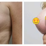 Breast Augmentation
