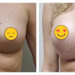 Breast Augmentation