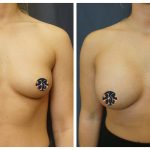 Breast Augmentation