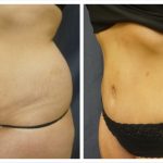 Abdominoplasty