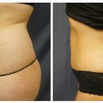 Abdominoplasty