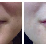 Lip Augmentation with HA filler