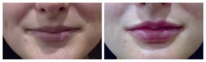 Lip Augmentation with HA filler