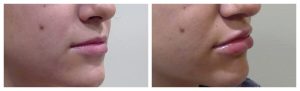 Lip Augmentation with HA filler