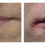Lip Augmentation with HA filler